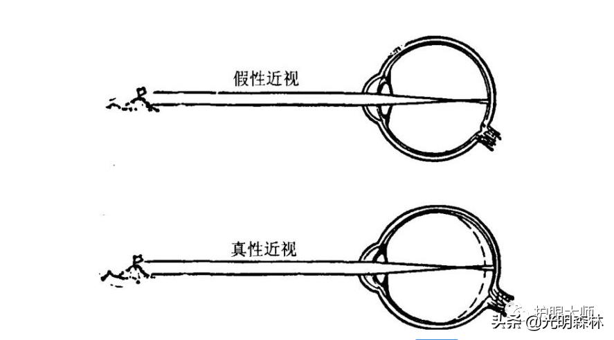 家长必读近视的防治,青少年近视治疗的误区