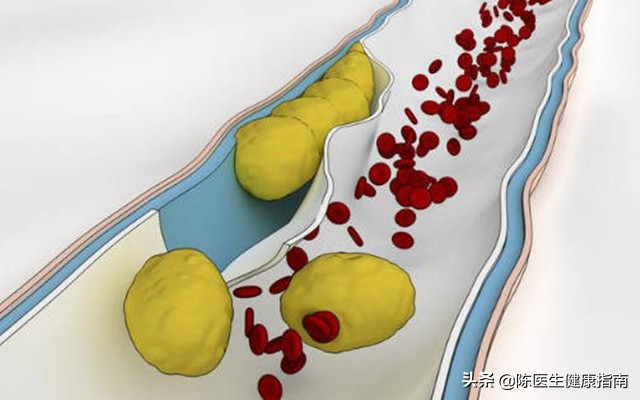 心梗医生说放支架,低密度脂蛋白多高容易脑梗心梗