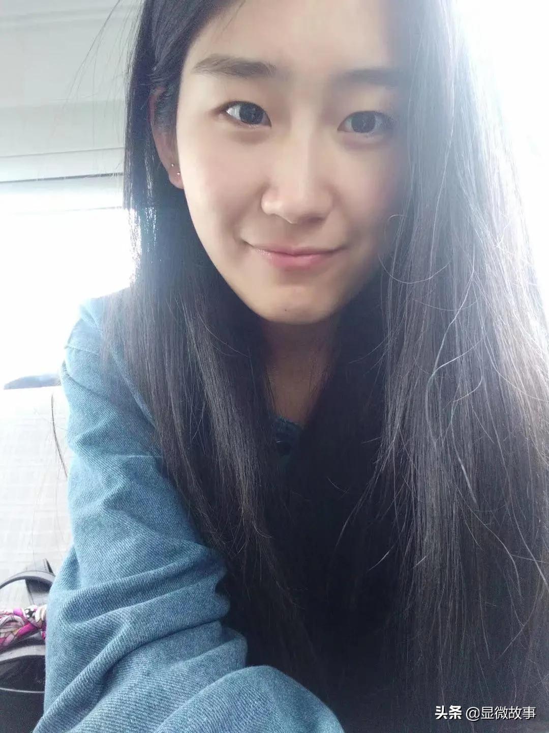 女子整容成猪鼻子取出6根肋骨,垫鼻子整容