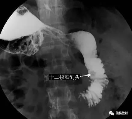 十二指肠球部溃疡解剖位置,十二指肠球部溃疡x线表现