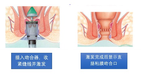 痔疮手术pph微创术多少钱,最安全的痔疮手术是哪种