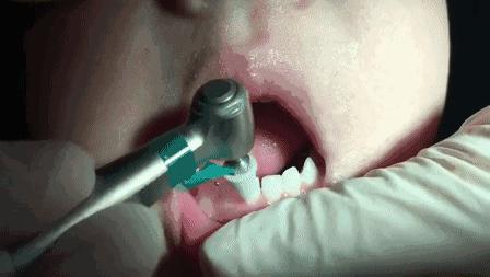 宝宝牙齿黄黄的刷不干净怎么办,宝宝不爱刷牙牙齿黑了怎么办