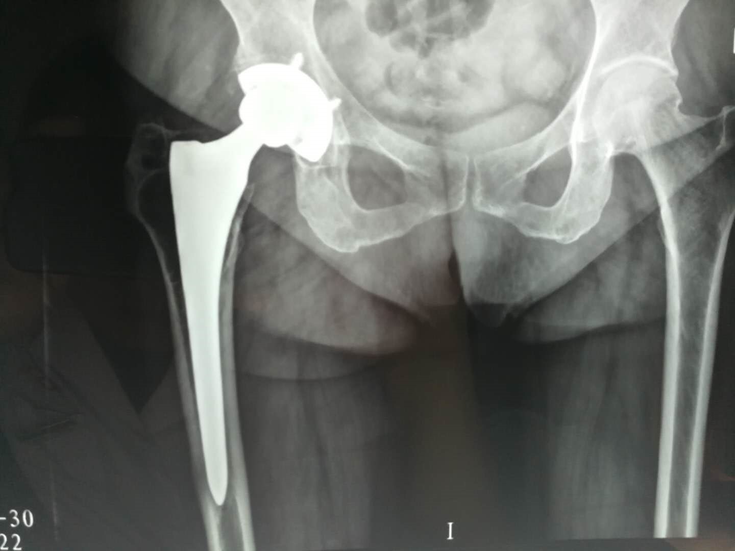 什么情况下会出现股骨头坏死,儿童股骨头坏死和成人股骨头坏死