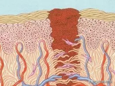 伤口结痂为什么会那么痒,伤口结痂处特别痒怎么回事