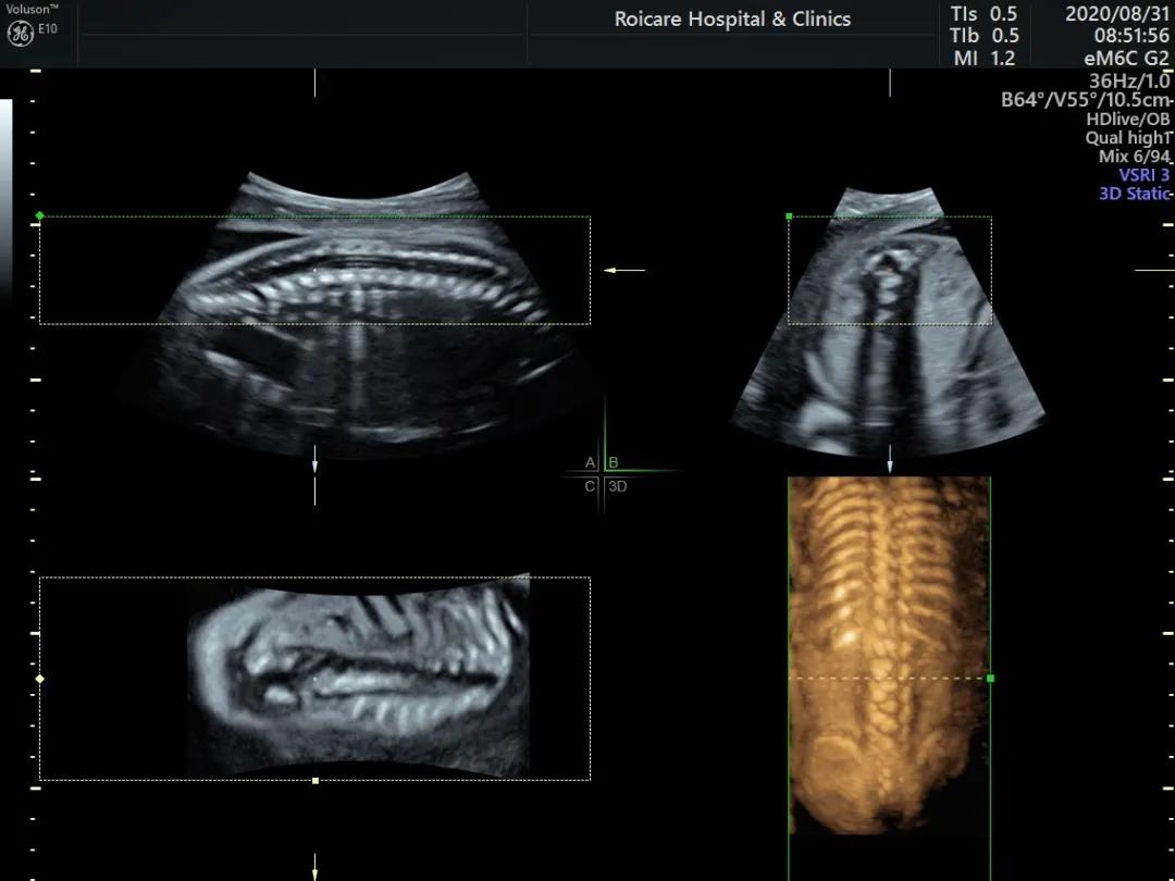 胎儿脊髓圆锥位置低是什么情况,胎儿脊髓圆锥位置偏低做核磁共振