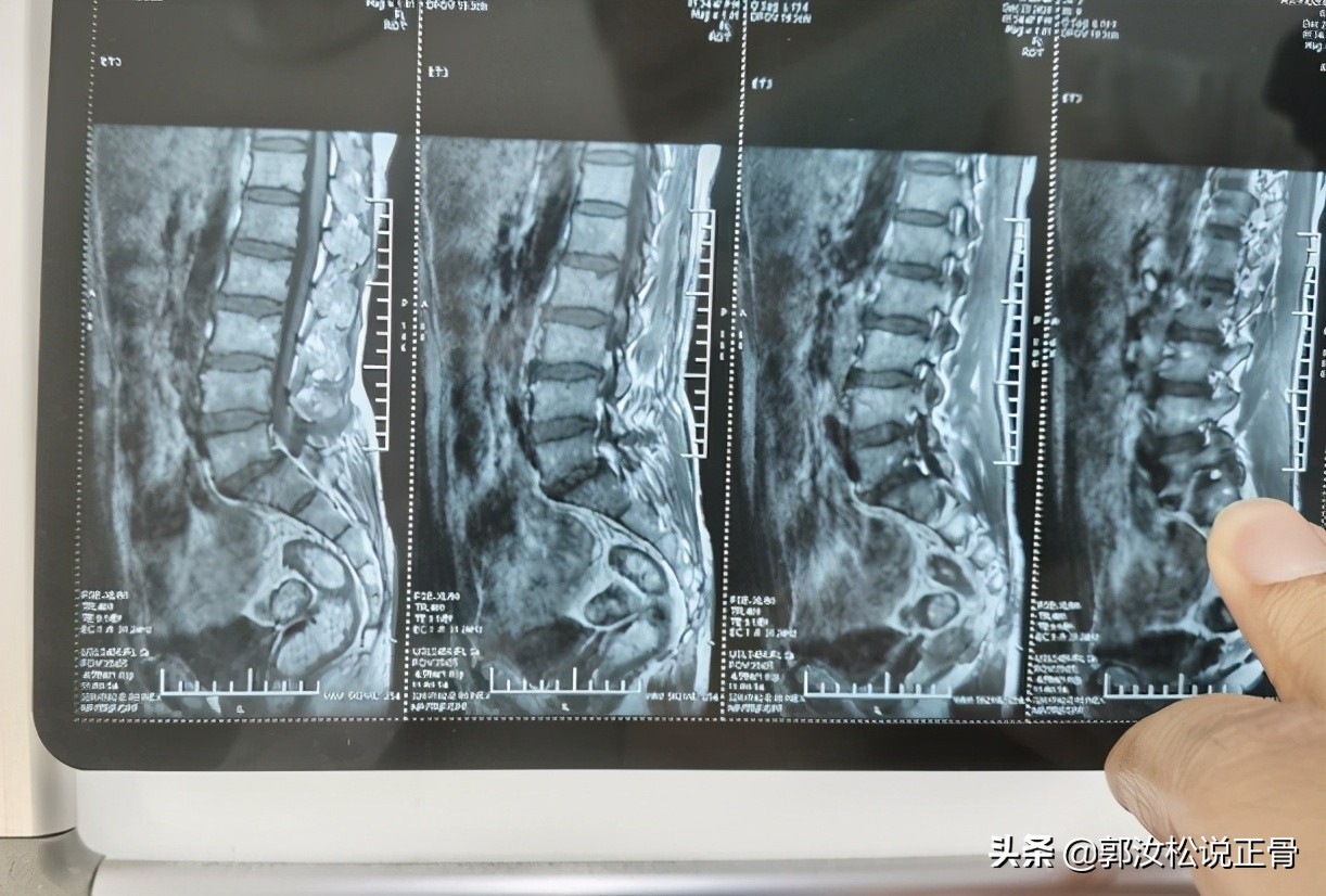 腰椎滑脱病例分析,腰椎滑脱症及手术方法的进展