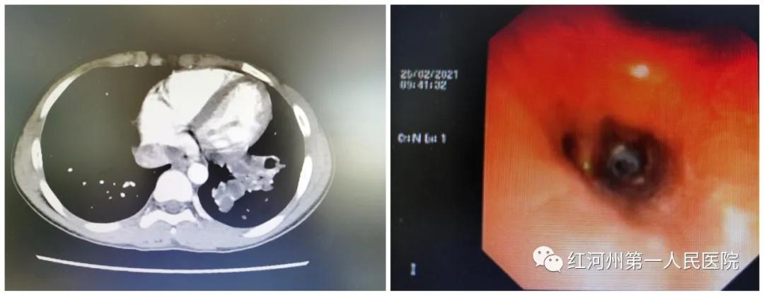 12岁男孩咳嗽三年了,13岁男孩半年咳嗽两次