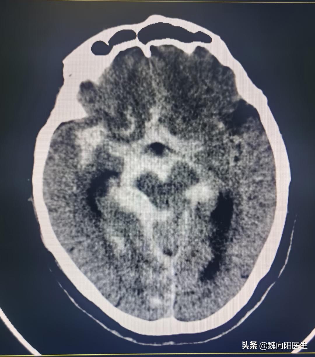母亲脑出血住院女儿拿四万,脑动脉血管瘤破裂费用可以报销吗