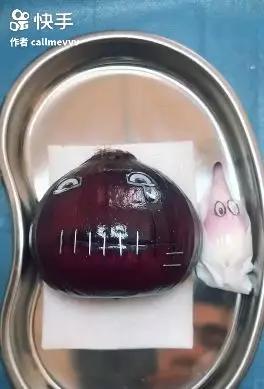 香蕉割包皮,洋葱剖腹产?这是我见过最秀的医生