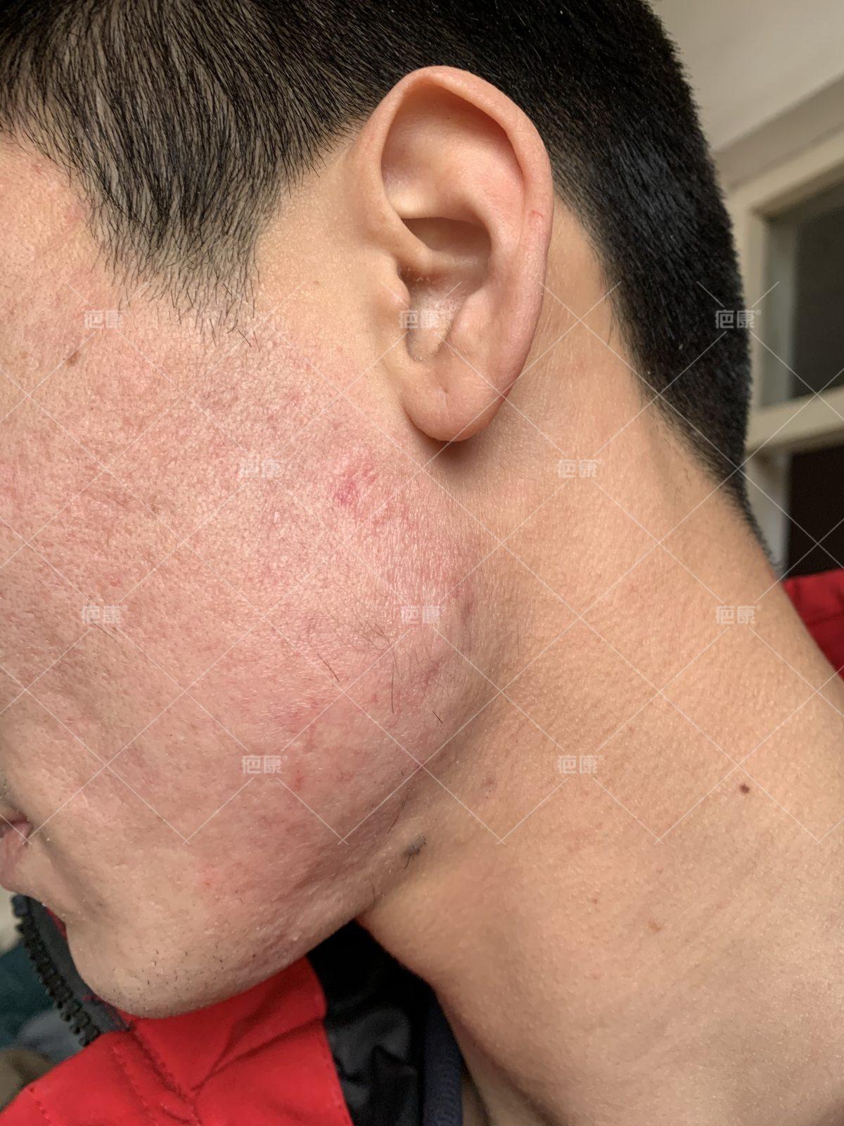 疤康净有效吗,疤康医院能治疤痕疙瘩吗