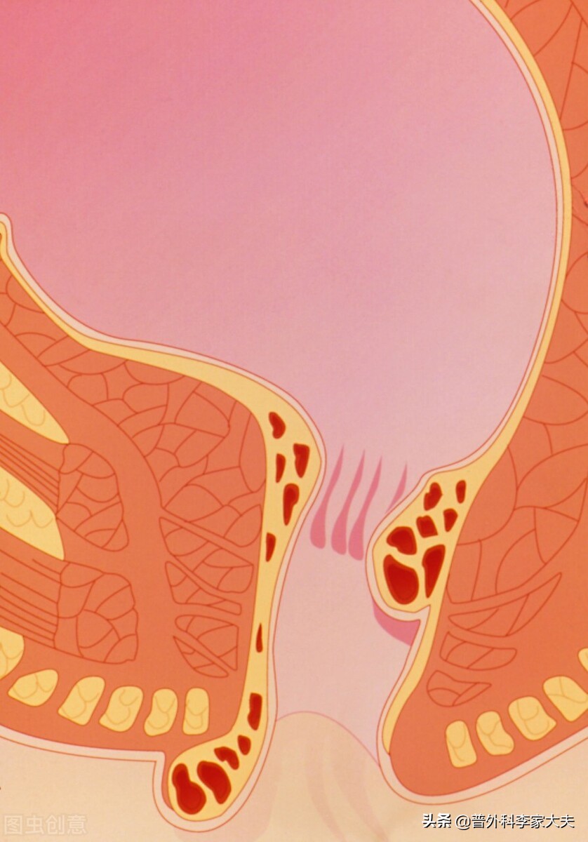 医生，为什么痔疮做了手术还是会复发？该如何是好？