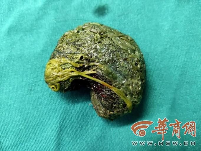 女孩因成绩不好被妈妈训斥,十二岁孩子异食癖怎么办