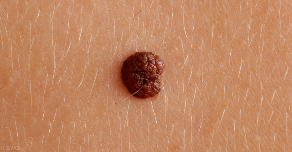 长这三种痣可能和癌症有关,长在这8个部位的痣需要注意了