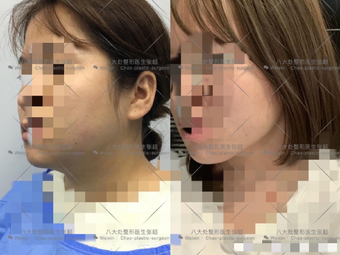 八大处整形张超,八大处张超最新视频