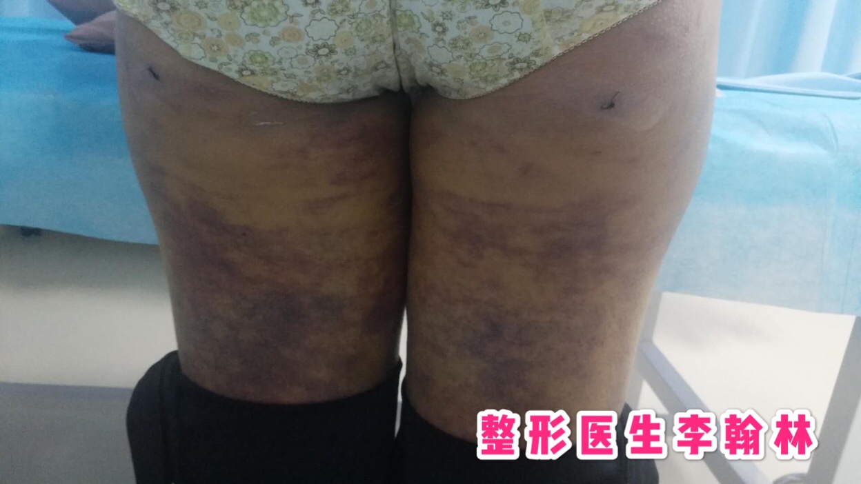 双下巴吸脂手术的危害,腹部吸脂手术有什么危害