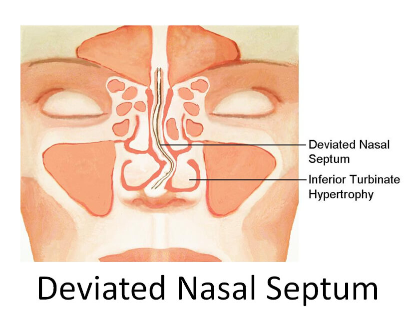 慢性鼻窦炎需要吃多久抗生素,鼻窦炎到底用什么抗生素