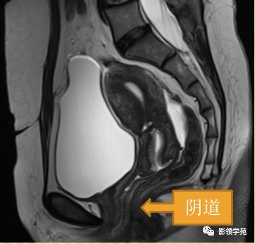 宫颈癌mri诊断,宫颈癌的mr扫描技术