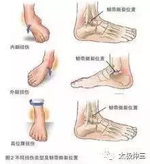 足踝的正确调整方法,如何保护脚踝的小妙招