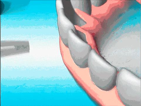 如何去除牙齿上的黑渍,如何去除牙齿上的黑渍用小苏打