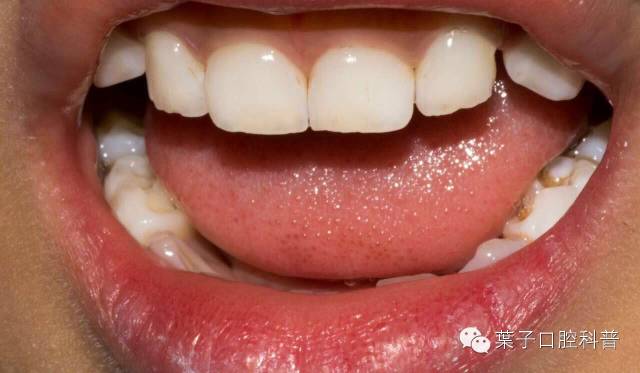 小朋友的牙菌斑要怎么去除,孩子有牙菌斑用什么刷牙