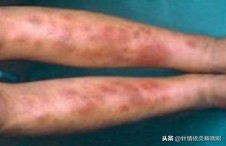 血管炎的针刺疗法,针灸治疗周围血管病