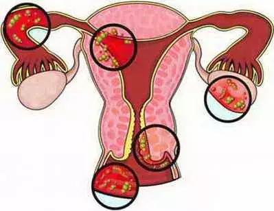 「备孕那些事儿」发病率较高的妇科炎症之一！中医综合治疗有妙招