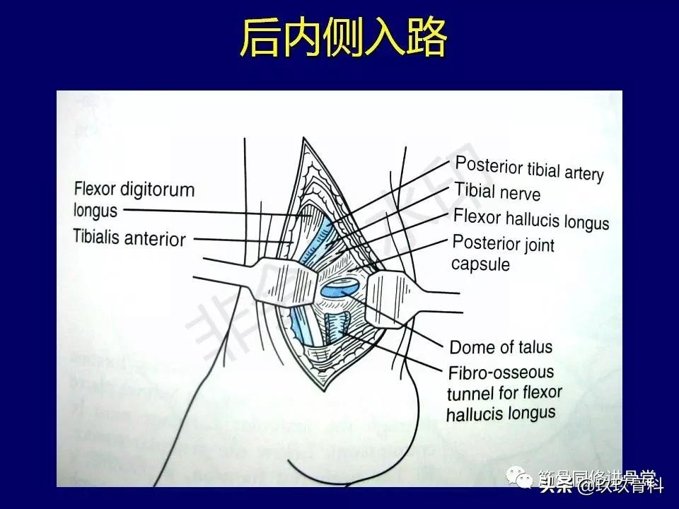 距骨骨折的治疗原则,距骨骨折如何调理