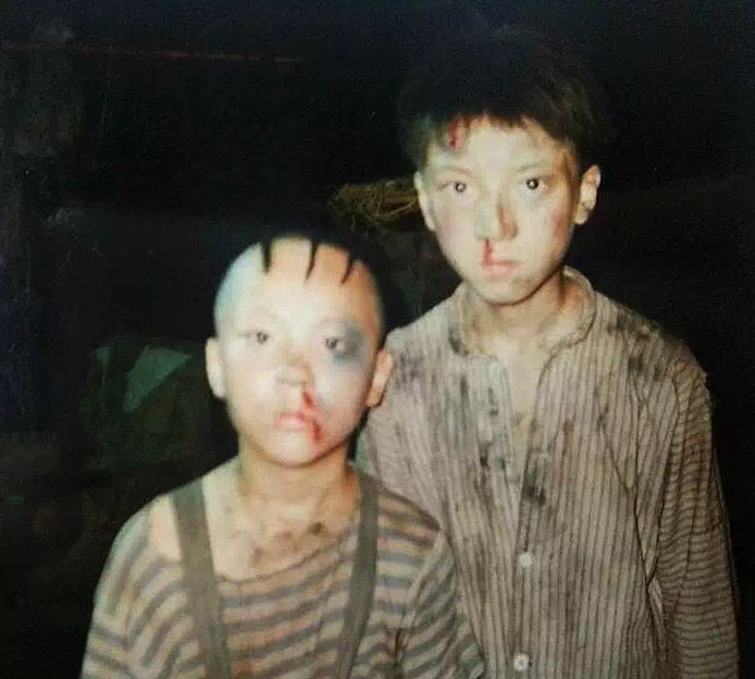 “三毛”34岁了！8岁爆火，14岁谢顶，植发挨300多针，如今变帅哥