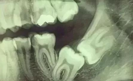 看牙不拍片直接说费用,医院看牙拍片贵吗