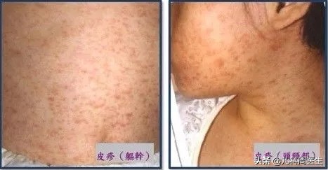 反复发热有没有可能是幼儿急疹,小孩急疹和热疹的区别