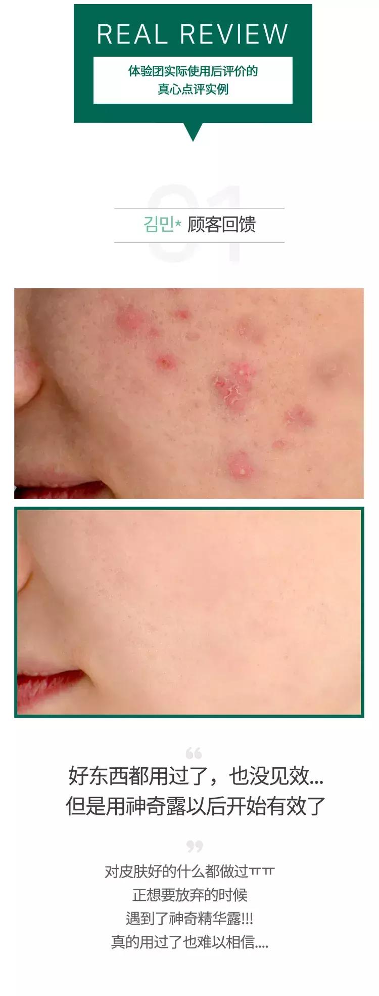 茶树somebymi爽肤水的使用方法,somebymi茶树精华