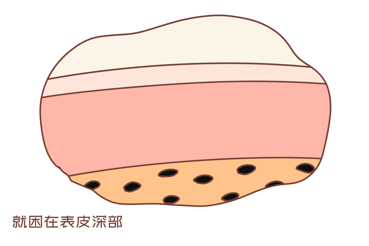 新生儿为啥身上有青色印记,为什么新生儿会腿淤青