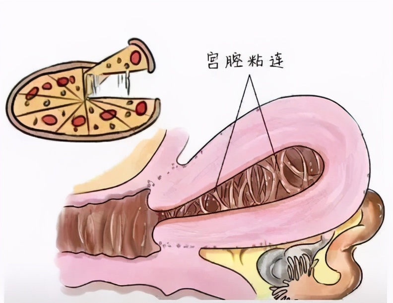 人流3次的子宫怎么样了,人流3次又怀孕可以保住吗