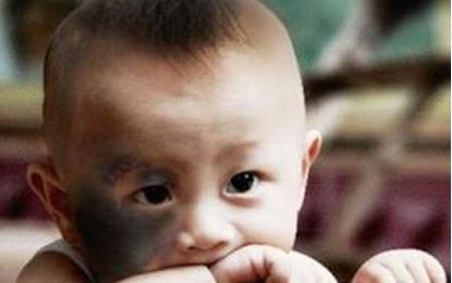 婴儿胎记激光治疗,新生儿胎记最佳治疗