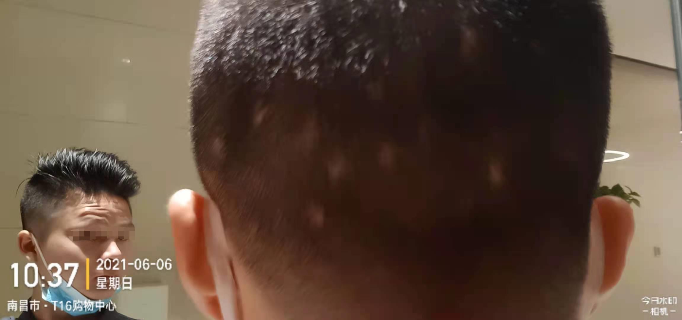 斑秃医美,深圳最好的斑秃治疗