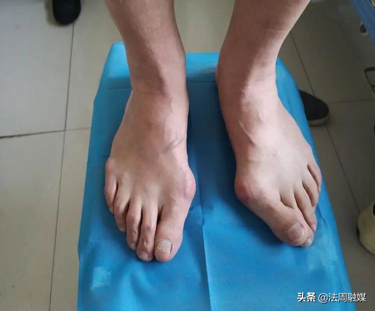 拇指长歪了?别慌!常德市第一中医医院专家帮您改“邪”归正