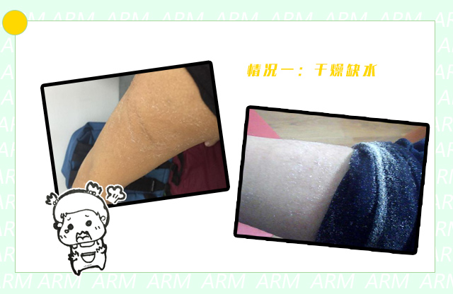 夏天胳膊粗怎么穿吊带才好,鸡皮肤非常严重怎么穿吊带