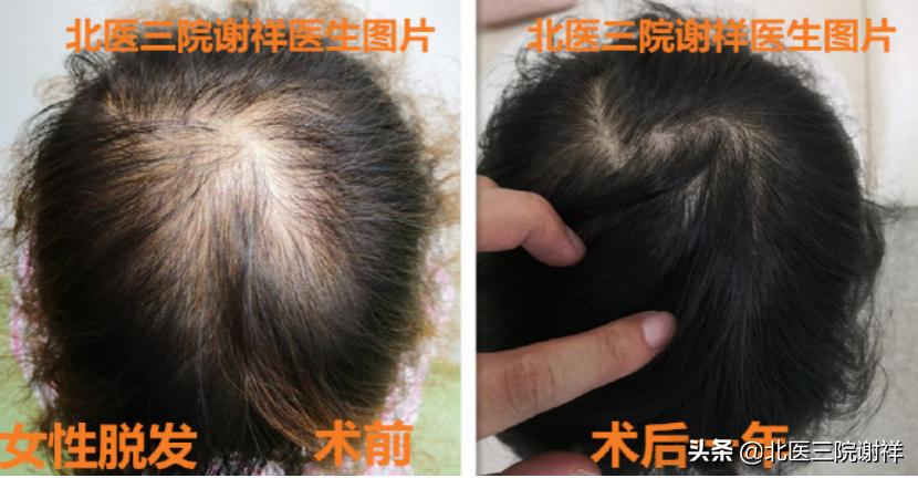 女脂溢性脱发怎么办 (女性脂溢性脱发如何治疗)