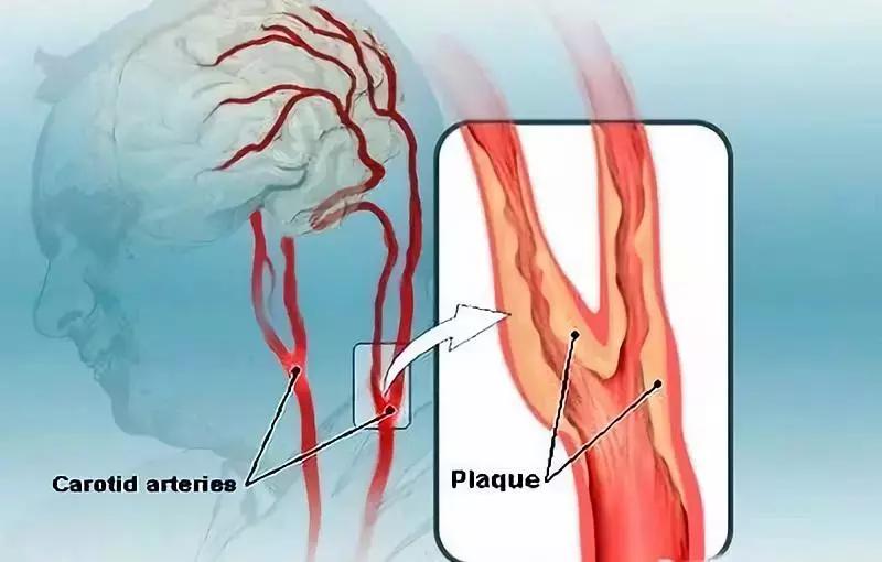 颈动脉有斑块怎么预防中风,双侧颈动脉斑块引发的脑梗中风