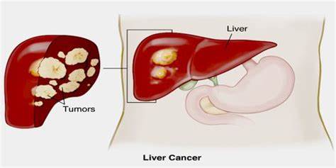 抗病毒后进展为肝硬化的几率大吗,抗病毒治疗后乙肝有传染性么