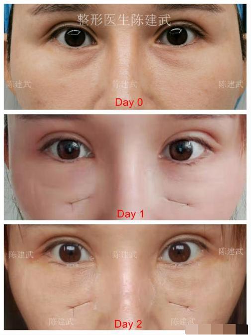 怎么样区分眼袋和泪沟,怎么区分泪沟和眼袋