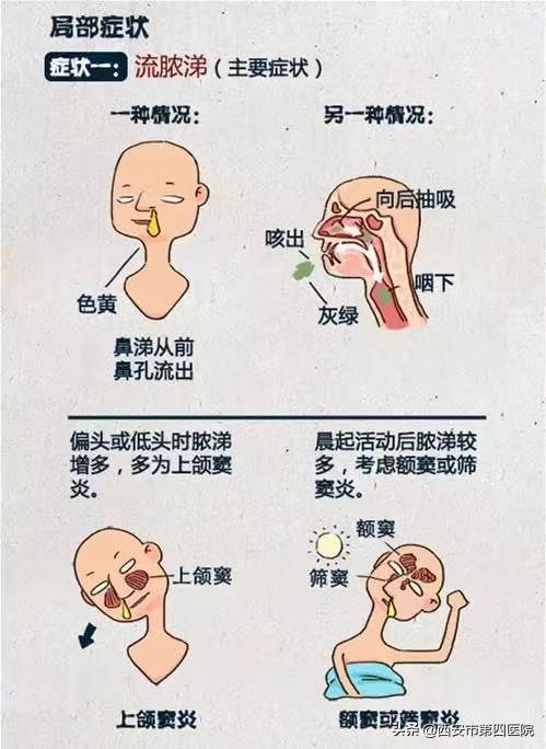 孩子流脓鼻涕是鼻窦炎吗,4岁宝宝鼻窦炎鼻塞流脓鼻涕