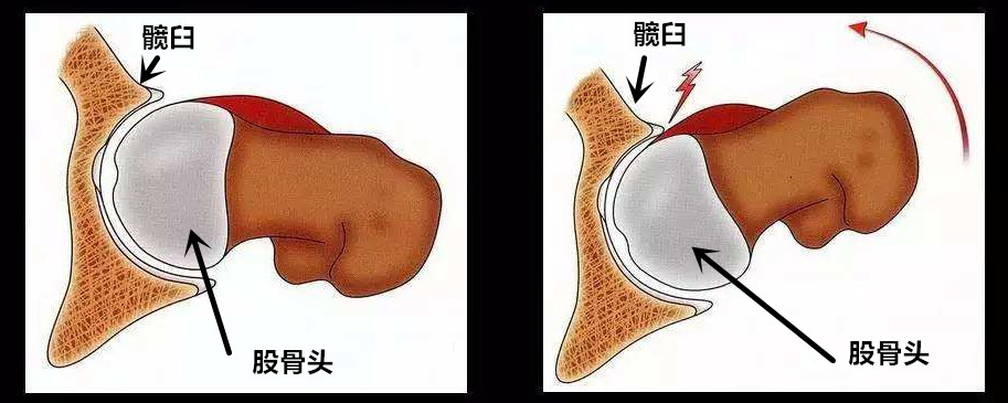 胯骨疼是不是骨折,胯骨疼是什么原因股骨头坏死