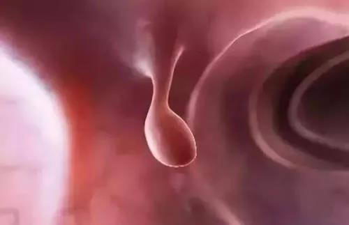 为什么肠息肉切除了还会长,为什么肠息肉切除了还会腹痛