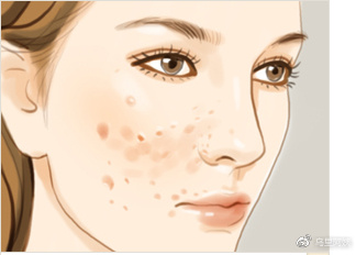 痘坑痘印|战“痘”达人的护理经验分享，内附修复攻略