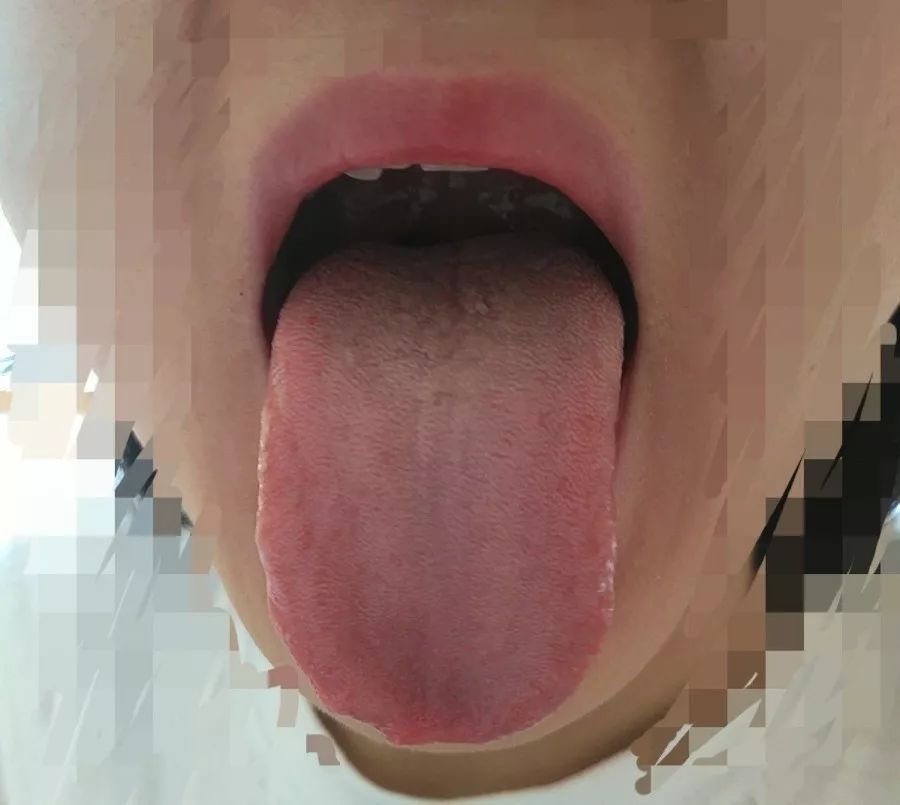 疏肝达郁法治崩漏,10年没断过的“大姨妈”终于恢复正常了