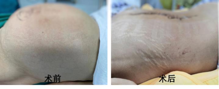 卵巢恶性肿瘤治愈案例,卵巢恶性肿瘤一年最快能长多少