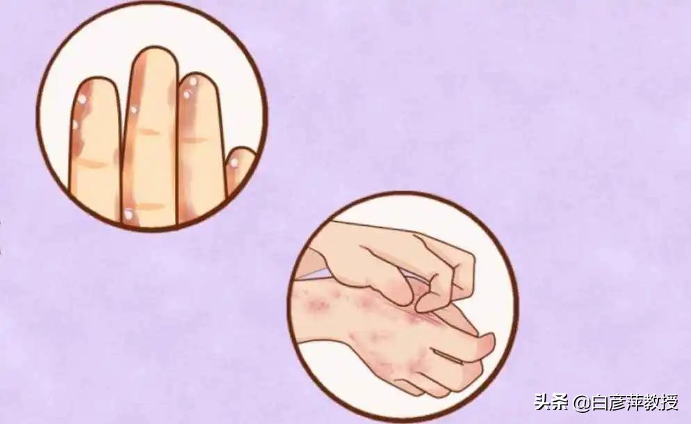 手部湿疹和手癣的鉴别要点主要为,手上起的小疱疹是癣还是湿疹
