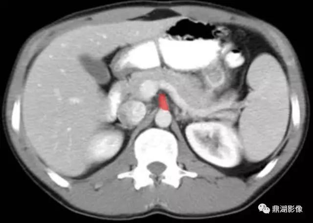 颈部胸锁乳突肌ct断层解剖图,骨盆骨质正常断层ct解剖图解