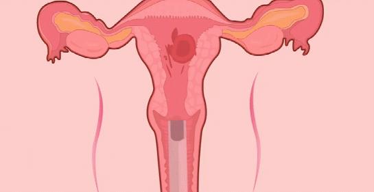 药物流产清宫还是不清宫,药物流产一星期还没干净正常吗